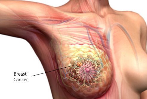 Breast Cancer - 5 Subtle signs of breast cancer