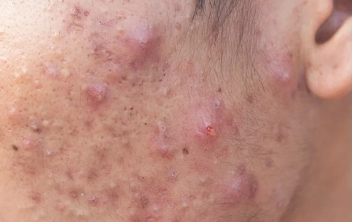 I attempted a couple of online entertainment hacks for skin break out They didn’t work!