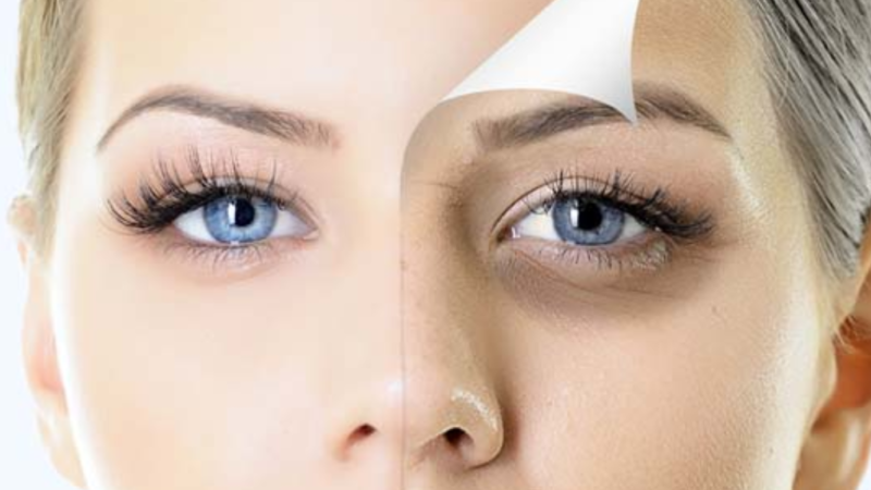 5 dark circles remedies are here!