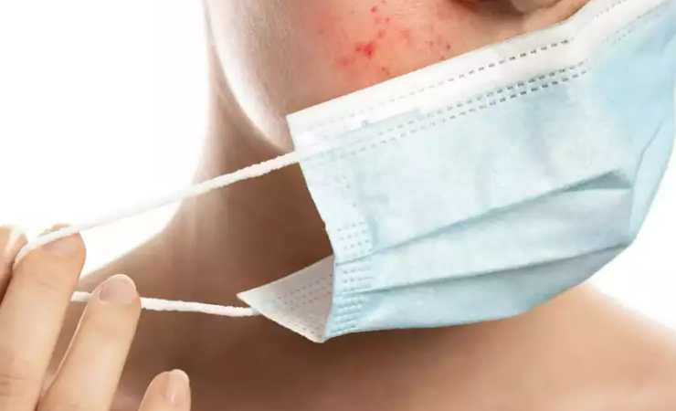 What you need to know about maskne Everything?