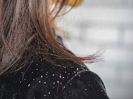 Dandruff treatments