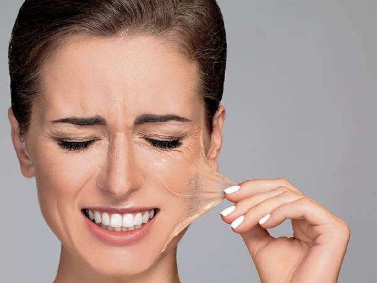 Risk caused by chemical peel