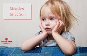 Measles viral disease