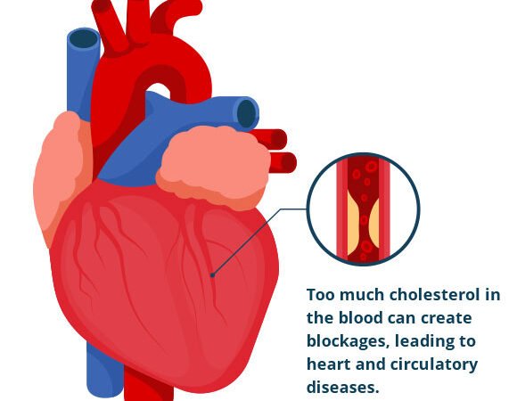 Elevated cholesterol: Severe agony in these pieces of the body could be an admonition sign