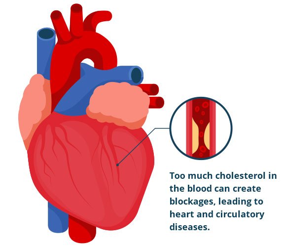 Elevated cholesterol: Severe agony in these pieces of the body could be an admonition sign