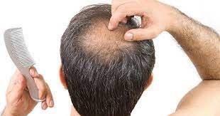 Hair Loss Due To Medical Conditions