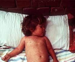 Measles viral disease
