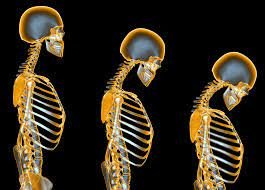 All about Osteoporosis