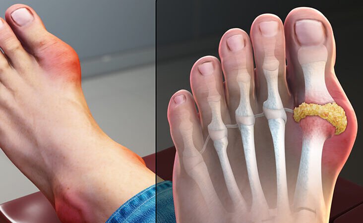 Gout versus Rheumatoid Arthritis What’re the distinctions