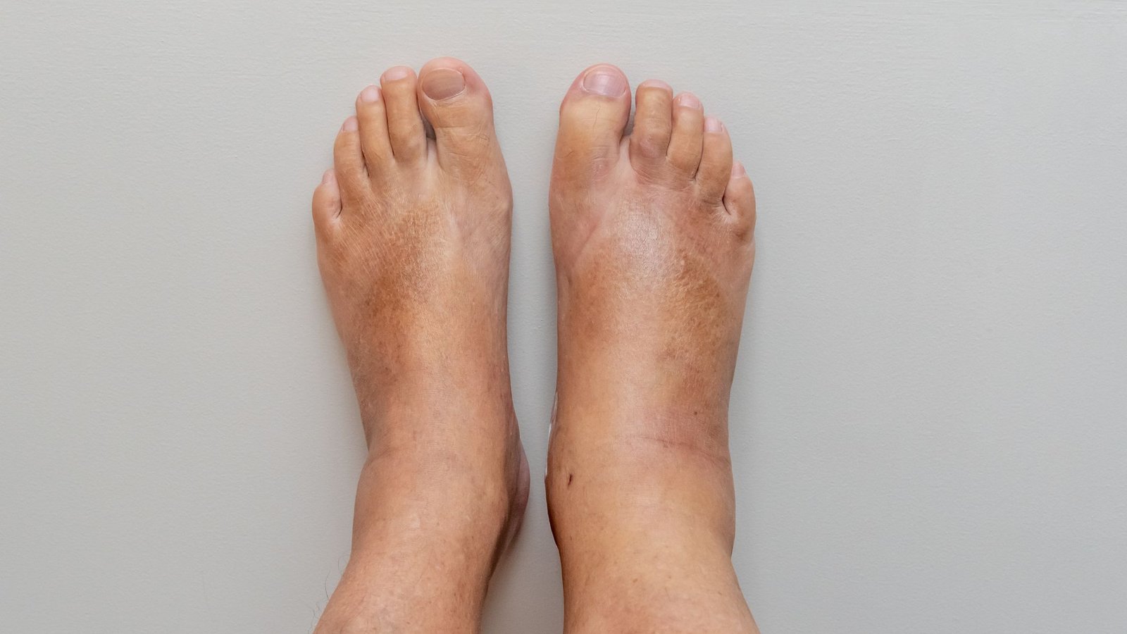 Reasons for continuous swelling