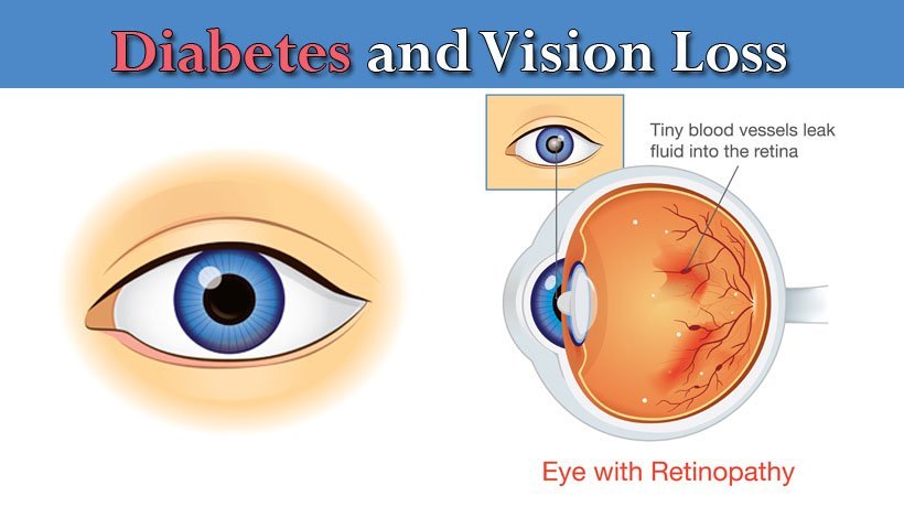 Four eye conditions brought about by diabetes