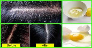 Home Solutions For Dispose Of Dandruff Normally