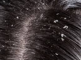 Home Solutions For Dispose Of Dandruff Normally