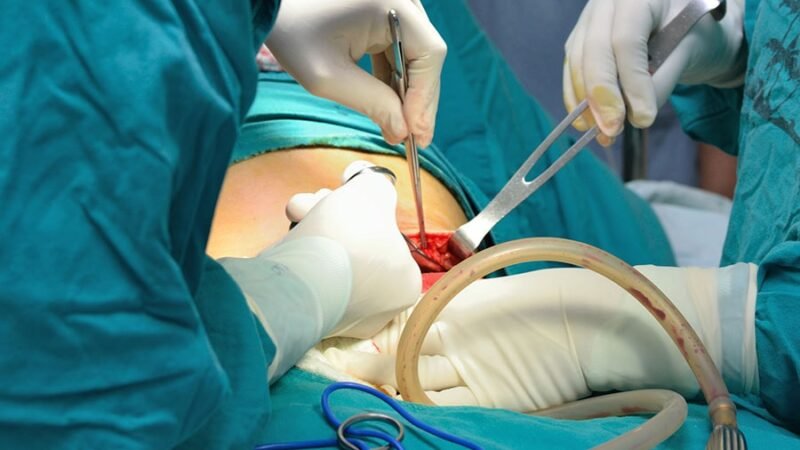 Scar of the C-area medical procedure