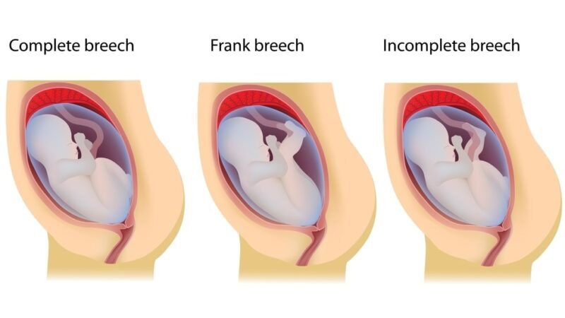 Breech Pregnancy