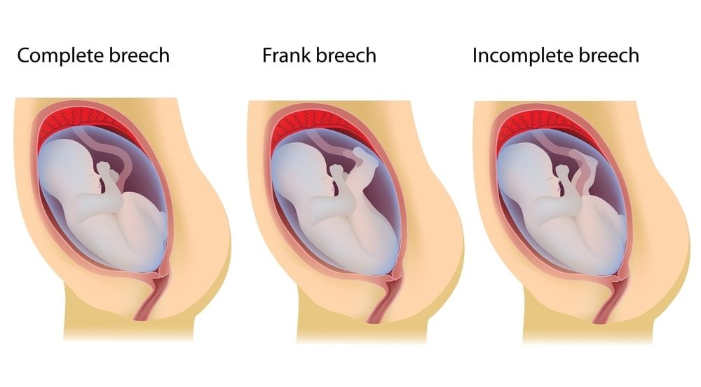Breech Pregnancy