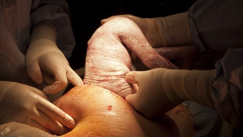 Try not to perform unwanted C-segments – warns WHO