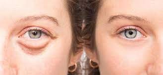 Castor Oil For Dark Circles Here's The Means By Which To Utilize It