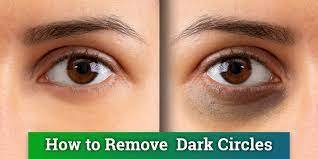 Follow these 4 tips to banish dark circles forever!