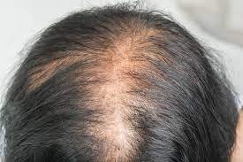 Top 10 justifications for why you might be losing hair