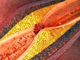 Heart Disease Show Signs Of Atherosclerosis