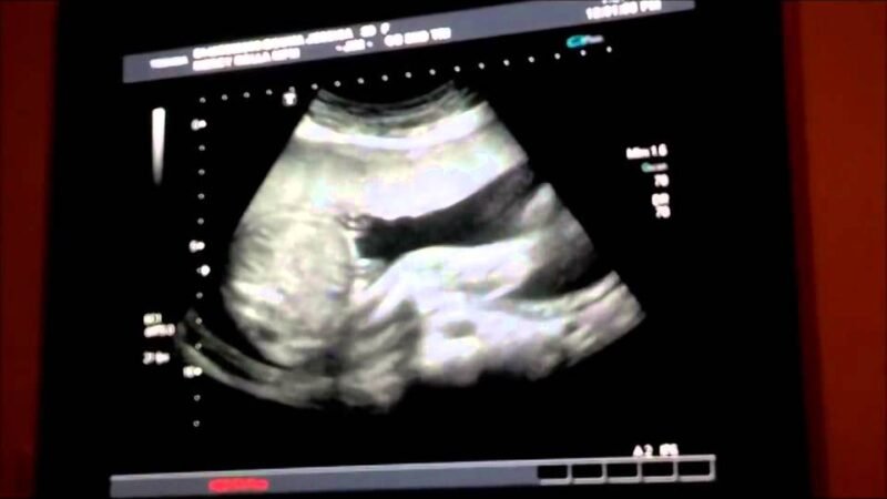 Sonography shows ‘string around the child’s neck’