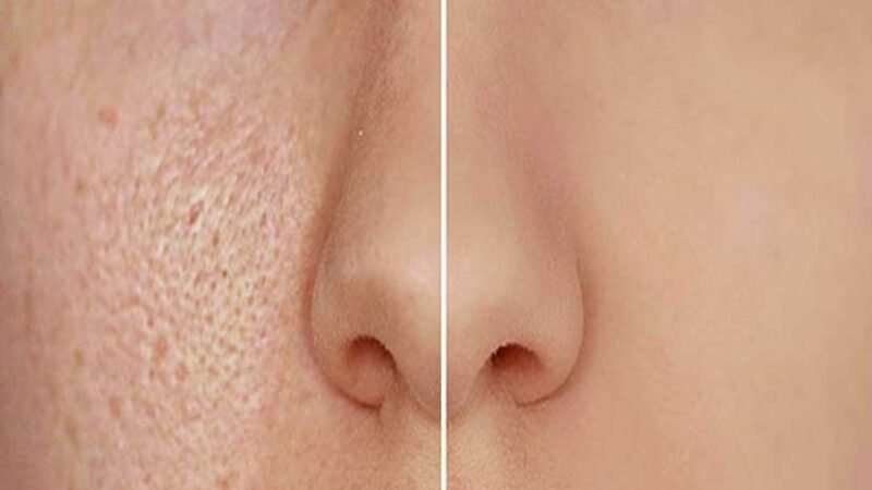 Need to dispose of huge pores? Attempt these