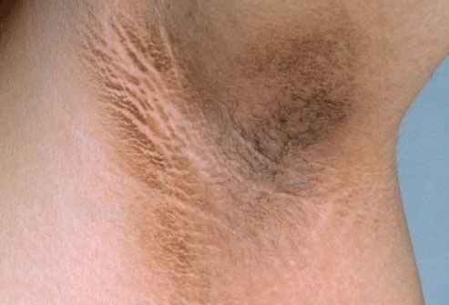 Dim underarms: Causes and cures