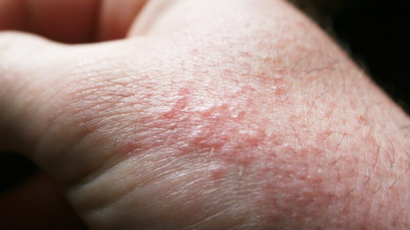 Skin inflammation During Summer