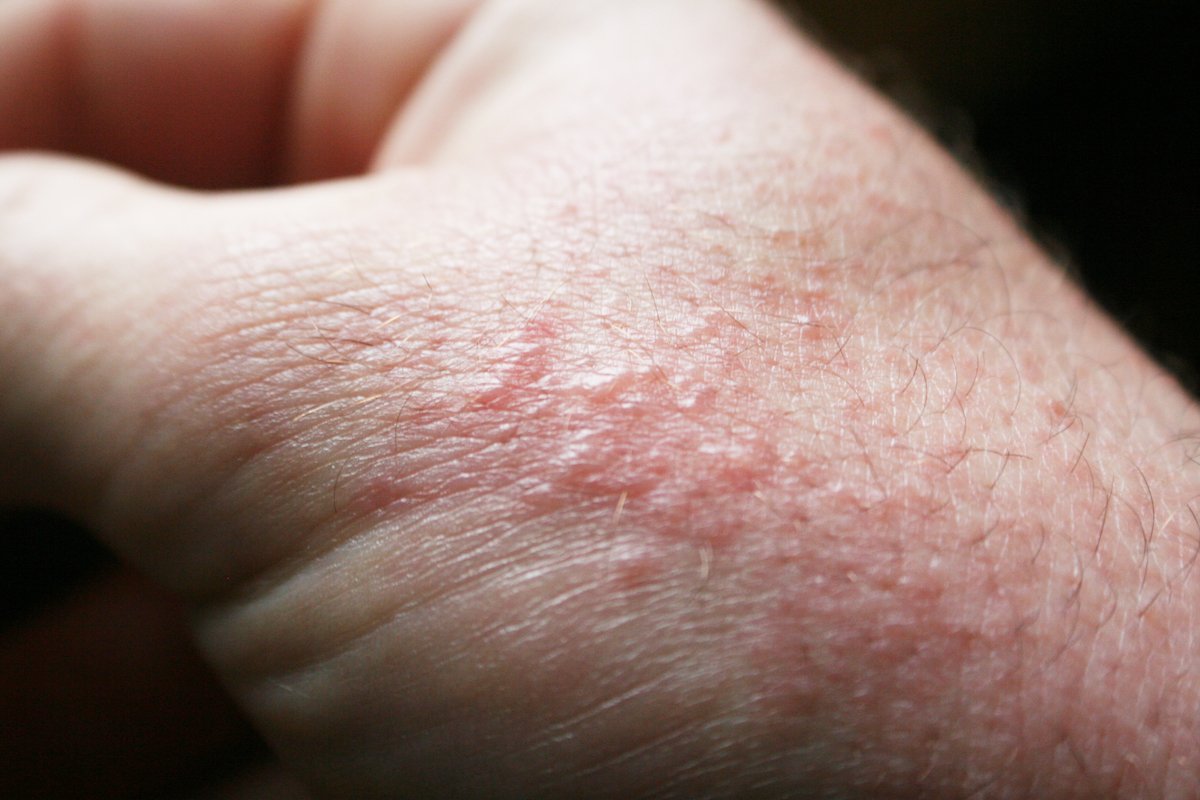Skin inflammation During Summer