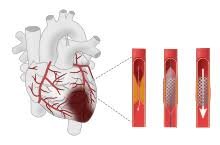 Myocardial infraction These elements can build your gamble of fostering the condition