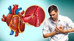 Myocardial Infarction Herbs for the heart in danger
