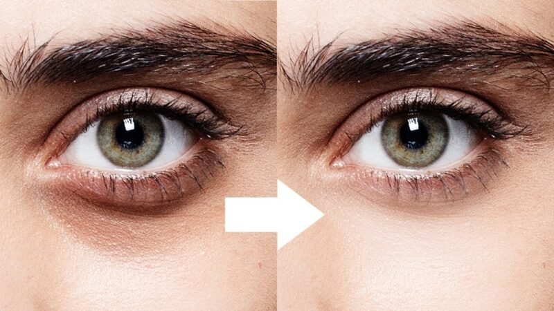 Effective method to dispose of dark circles