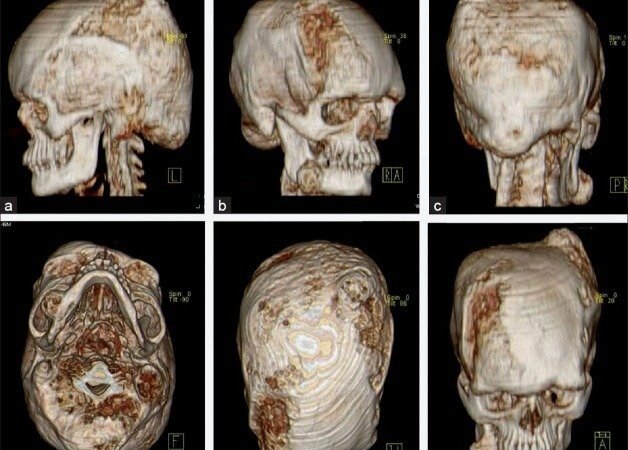3D imaging surgery for rare skull problem