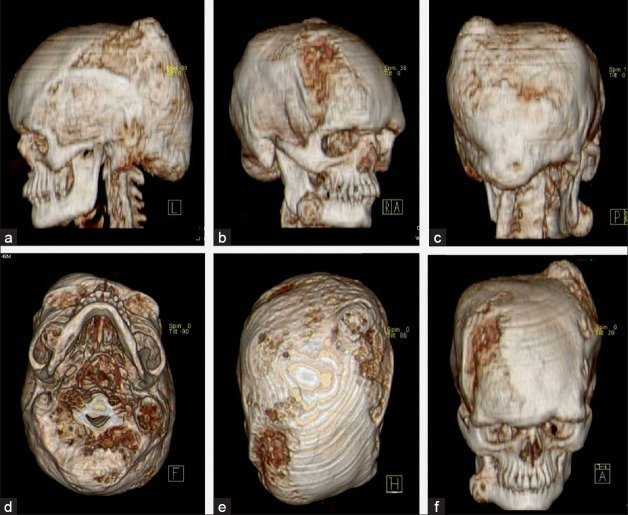 3D imaging surgery for rare skull problem