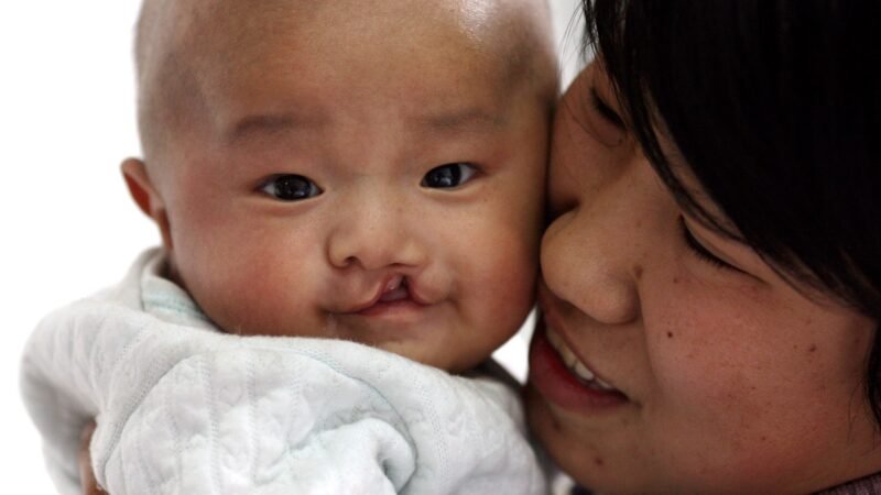 72,000 kids and adult have cleft lip and palate