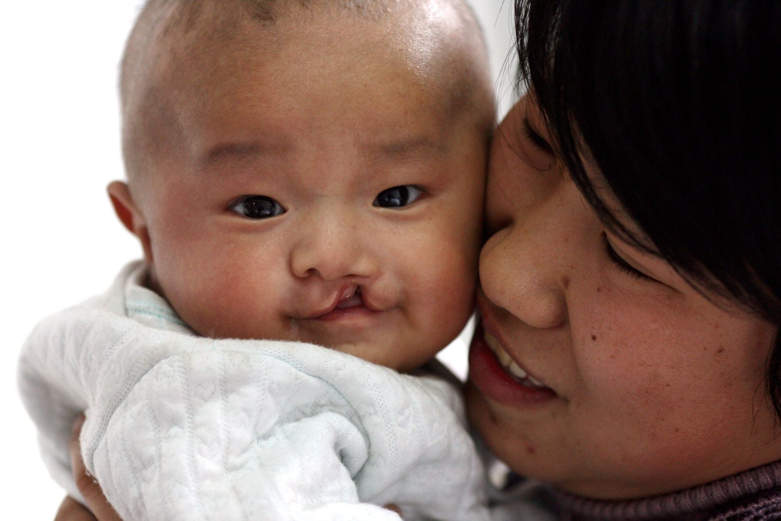 72,000 kids and adult have cleft lip and palate