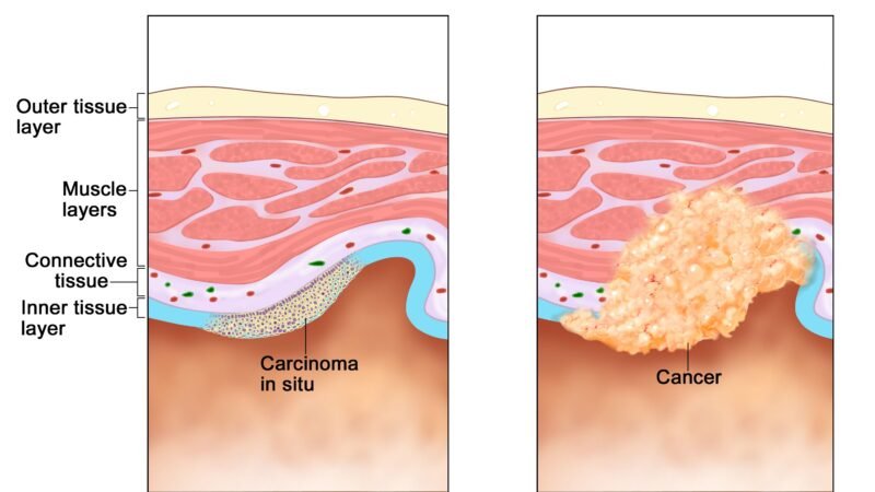 Your Definitive Malignant growth Glossary