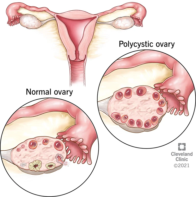 Ovarian Disease Can’t Stop pregnancy