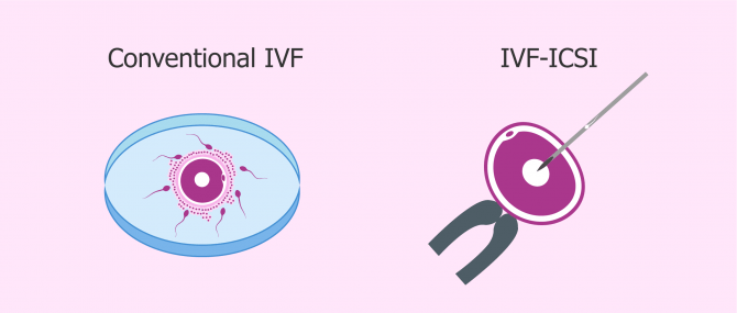 IVF Conveyance Relies Upon Male Accomplice
