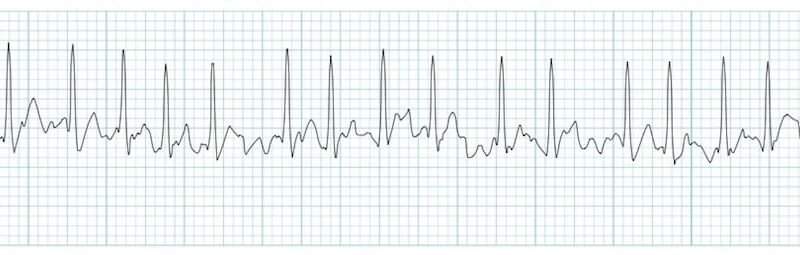 Atrial Fibrillation By 16%