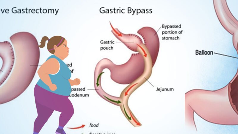 Bariatric Medical procedure for weighting