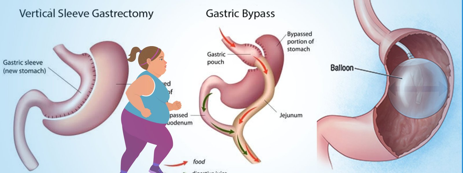 Bariatric Medical procedure for weighting