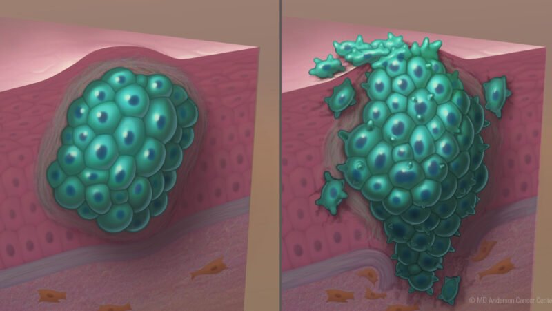 Malignant growth Lifts Barrenness