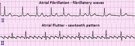 Atrial Fibrillation By 16%
