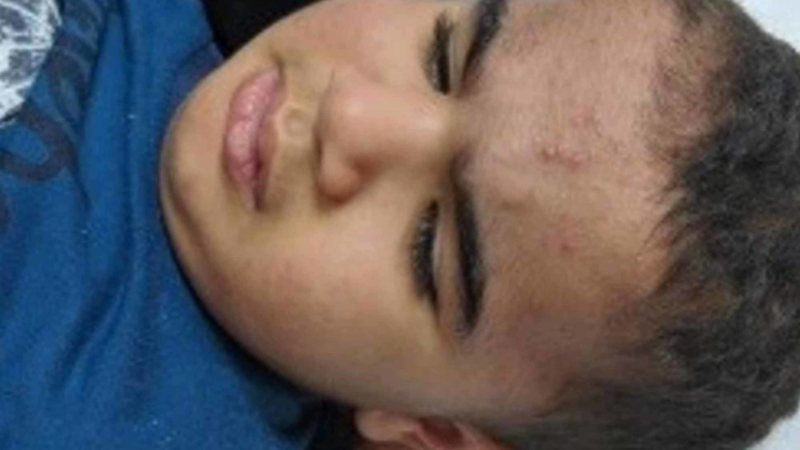 Pre-Pubertal boy Impacted By Malignant growth