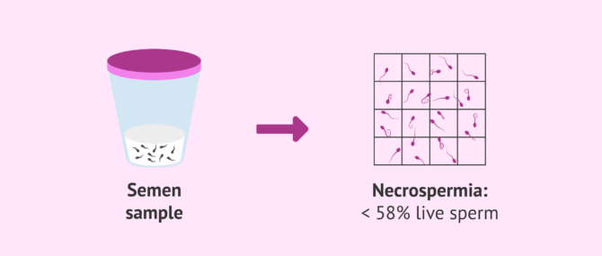 What Is Necrozoospermia In Men