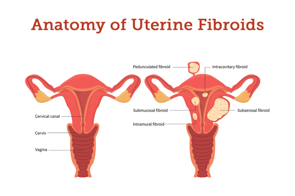 Uterine Fibroid: Medicines need to be aware